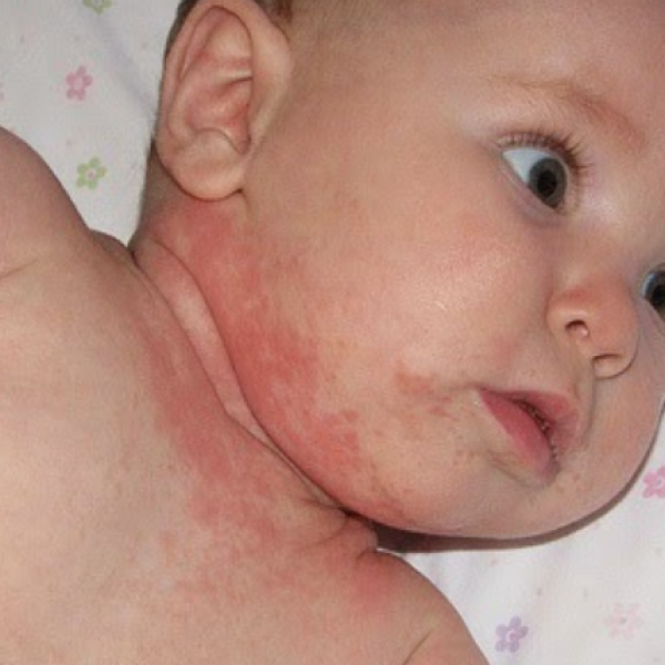 CÁC DẠNG VIÊM DA DỊ ỨNG Ở TRẺ NHỎ – CHA MẸ ĐỪNG LẦM TƯỞNG 